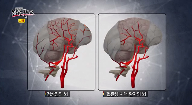 혈관성 치매란 뇌혈관 질환에 의해 뇌조직이 손상을 입어 치매가 발생한 경우를 일컫는다. 오른쪽 혈관성 치매 환자의 뇌는 정상인의 뇌와 큰 차이를 보인다. 채널A 방송화면 캡처