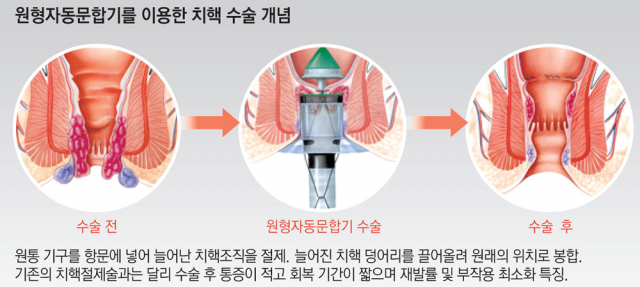 원형자동문합기를 이용한 치핵 수술 개념