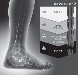 발목염좌 단계별 상황