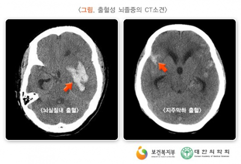 출혈성 뇌졸중의 CT 상의 소견 (자료:대한의학회)