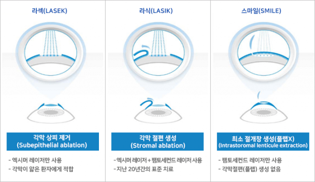 라섹, 라식, 스마일라식 수술 개념 비교