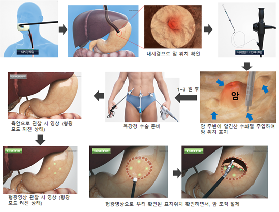알긴산 기반 근적외선 형광 수술 표지자를 이용한 정밀 위암 수술 모식도. 해수부 제공.