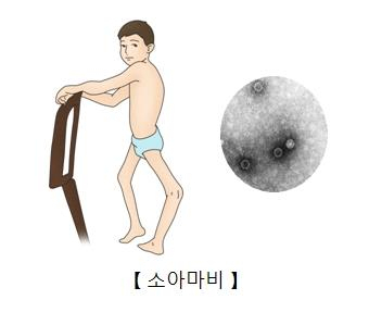 소아마비. 서울아산병원