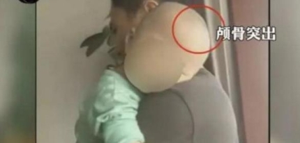 중국에서 가짜 분유를 먹은 유아들이 두개골이 커지는 부작용을 앓아 논란이 되고 있다. 중국 신경보 캡처