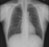 44세 남자 환자. 흉부 X-ray 영상으로는 정상 소견.