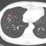 흉부 X-ray로는 안보였던 병변이 저선량 흉부 CT 영상에는 우측폐 하엽 전분절에 작은 비고형성 결절 보임. 폐암으로 확진됨.