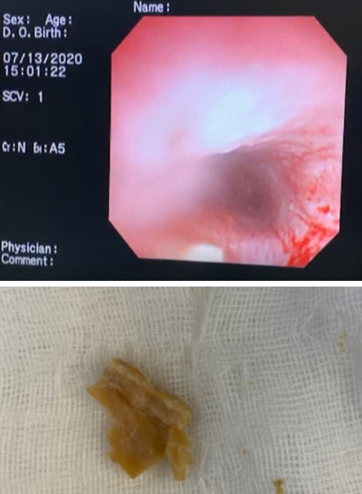 까미의 흉부 식도에서 내시경으로 제거한 개껌 (1.5cm *3cm) (아래사진), 2kg의 소형견 까미에게는 심각한 위협이었다. 흉부 식도에 정체된 이물은 시간이 지나면서 식도 점막과 유착되기 시작한다. 까미의 경우 유착된 식도 점막에서 소량의 출혈은 발생하였지만 심각한 감염증은 관찰되지 않았다. (윗사진) (탑스동물메디컬센터)