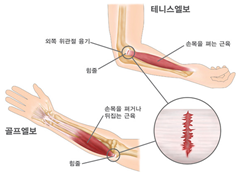 〈엘보 자가진단법〉그림출처: MK 한방병원