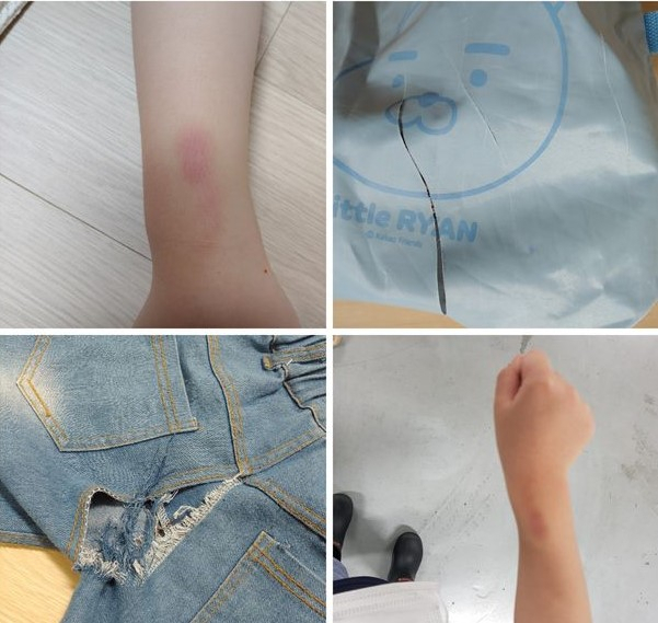 해당 청원인이 주장한 아동학대 흔적. 온라인커뮤니티 캡쳐