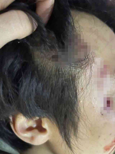 로트와일러 개물림 사고를 당한 A씨. 온라인 커뮤니티