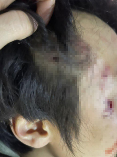 로트와일러 개물림 사고를 당한 A씨. 온라인 커뮤니티