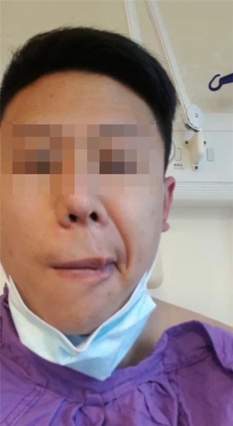 시노백 백신을 접종 받은 후 안면마비 증상이 왔다고 주장하는 월슨 람. SCMP 홈페이지 캡쳐