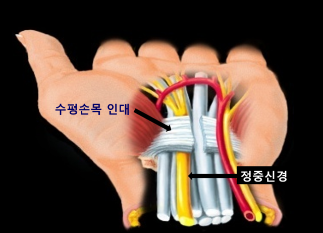 정중신경이 수평손목목인대에 눌리는 손목터널 해부학 모습.