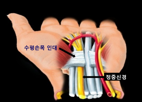 [삶의 질 떨어뜨리는 질환] ⑦손저림 대표 질환-손목터널증후군