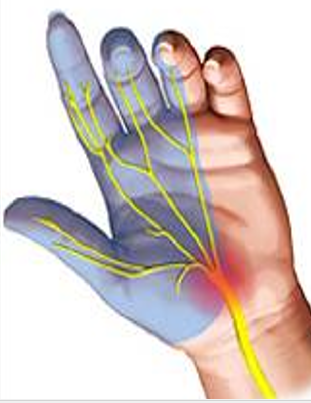 손목 터널 증후군의 주된 승상은 손저림과 손의 감각 이상으로 특히 엄지와 검지를 중심으로 증상이 더 심하게 나타난다.