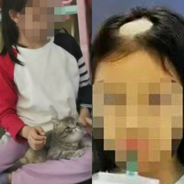 고양이를 키우다 1주일만에 원형탈모를 얻은 중국 소녀. 연합뉴스