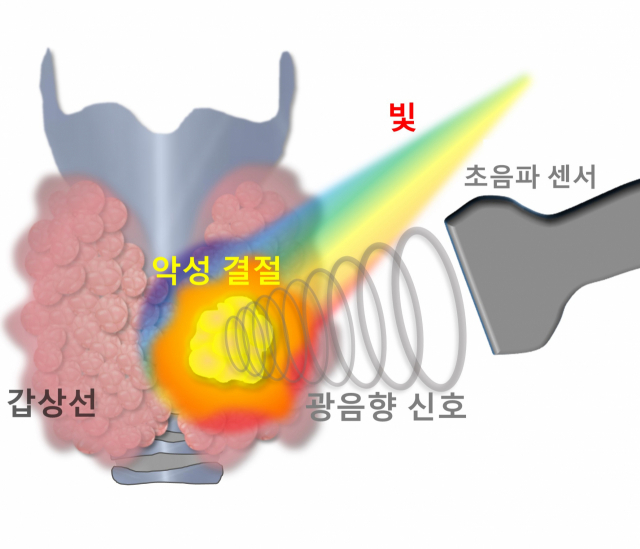 악성갑상선 결절에 레이저 빛을 조사할 때 발생한 광음향 신호를 초음파 센서로 얻고 있다. 포스텍 제공