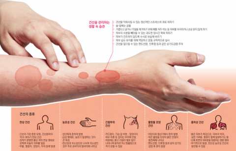 [건강플러스] 중증 건선 환자 생물학적제제 투여하니…