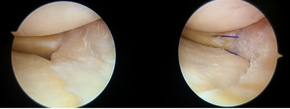 50대 남자 환자로 무릎을 움직일 때 지속적인 날카로운 통증이 3개월 이상 지속돼 MRI 검사를 실시했는데, 방사선 형태의 파열이 있어 관절경으로 부분적 제거술 시행했다.