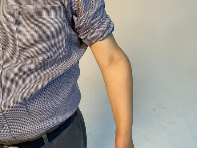 더불어민주당 대권주자인 이재명 후보는 17일 소년공 시절 부상으로 비틀어진 자신의 팔 사진을 공개했다. 장애로 병역의무를 이행하지 않은 것을 비난하는 이른바 