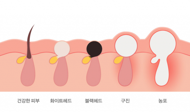 여드름의 유형