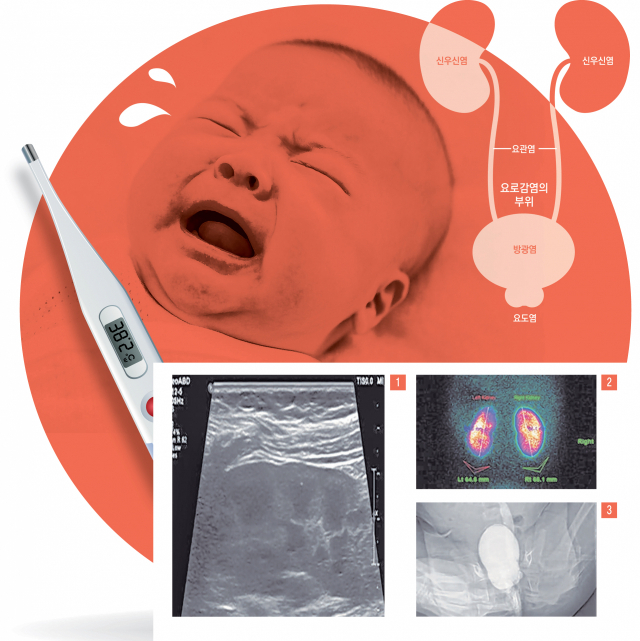 요로감염을 진단받은 8개월 여아의 검사 결과-신장초음파검사(1)에서 정상으로 확인되었으나, 핵의학검사(2)에서 좌측 신장에 손상이 확인돼 시행한 역류검사(3)에서 좌측 신장에서 방광요관역류가 확인됨. 조민현 교수 제공
