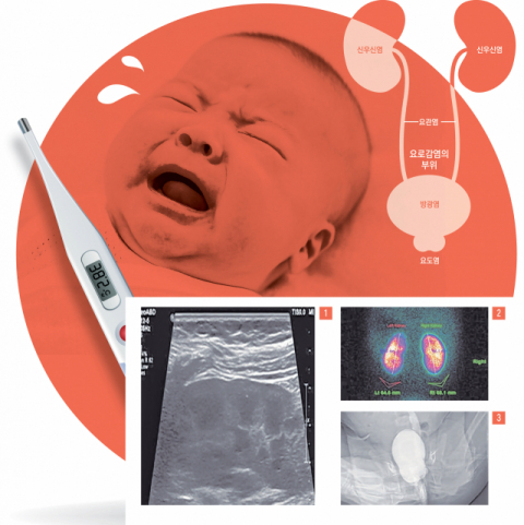 [건강플러스] 이유 없이 고열 나는 아이, 소변검사부터…소아 요로감염
