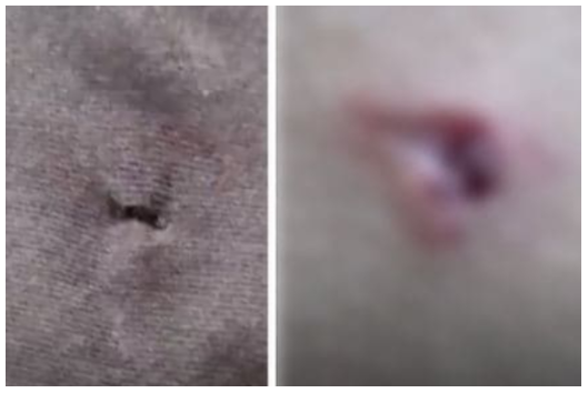 피해학생 측이 공개한 화살을 맞은 부위 상처 사진. CBS라디오 김현정의 뉴스쇼 캡처