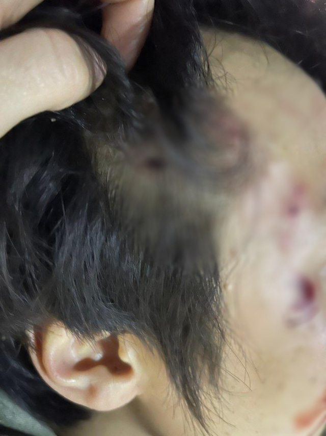 지난 5년 동안 하루 평균 6명이 개에 물린 것으로 나타났다. 로트와일러 개물림 사고를 당한 A씨. 온라인 커뮤니티