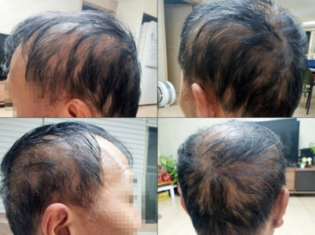코로나19 백신 2차 접종 후 심각한 탈모 증세에 시달리고 있다는 A씨. 연합뉴스