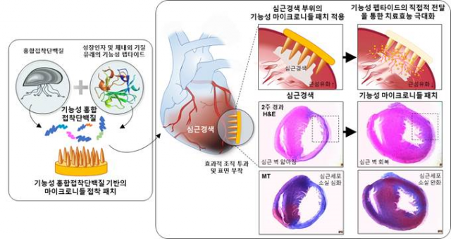 심근경색 치료용 기능성 마이크로니들 접착 패치 모식도. 포스텍 제공