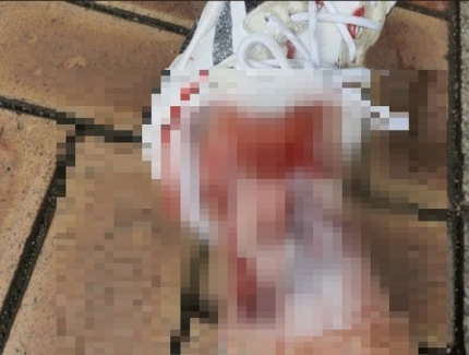 대형견 물림사고. 피해자 SNS 캡처