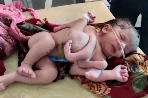 팔·다리 각각 4개 씩 갖고 태어난 인도 아기…가족들 