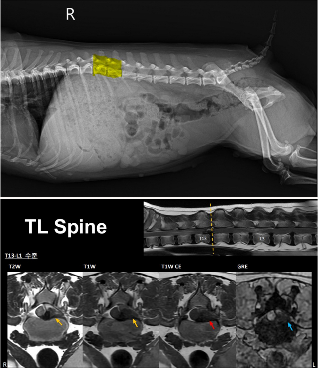 반려견 디스크질환 (IVDD)은 X-ray검사( 위 사진)로는 진단이 어려우며, MRI 검사(아래 사진)를 통해 확진이 가능하다. MRI 검사에서 흉추 13번과 요추 1번 사이의디스크가 파열되어 척수신경이 70% 강하게 압박되고 있음이 관찰되어 응급수술 대상으로 판별되었다,( 이미지출처 : 박순석동물메디컬센터, 경북대학교 부속동물병원 )