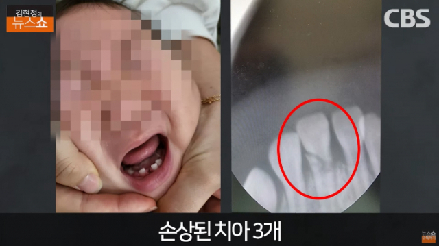 경남 양산의 한 어린이집에서 13개월 피해 여아의 치아가 부러지는 등 상습적인 아동학대가 벌어진 의혹에 대해 경찰이 수사에 나섰다. 이 사진은 피해 여아 부모가 공개한 치아가 손상된 모습. CBS 김현정의 뉴스쇼 영상 캡처