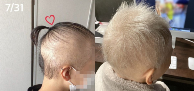 모더나 백신 1차 접종 후 탈모 증세를 호소하던 일본 20대 여성 A씨의 과거 모습(좌)과 최근 모습(우). 사진 A씨 블로그 캡처