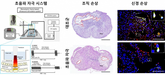 초음파 치료 관련 이미지. 케이메디허브 제공