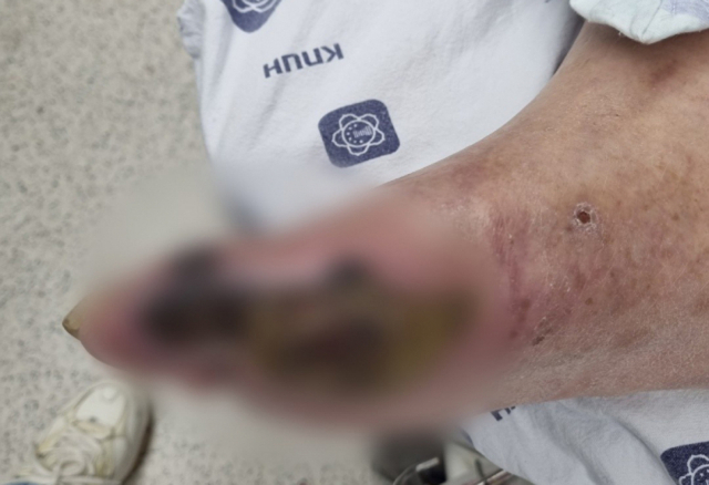지난 3월 25일 대구 한 대학병원에서 보호자가 찍은 환자의 괴사된 발. 수성구 한 요양병원에 입원해있던 환자는 몸 상태가 나빠져 이곳으로 옮겨졌다. 보호자는 요양병원이 진료 기록부를 누락했을 뿐만 아니라 환자에 대한 치료도 제대로 하지 않았다고 주장하고 있다. 심헌재 기자