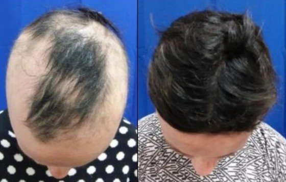 미국 한 제약회사가 머리카락의 80%가 재생되는 탈모치료 신약을 개발했다. 뉴욕포스트