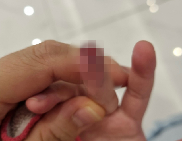 2일 달서구의 한 유치원에서 6살 아동이 수업 도중 자동 스탬프에 찍혀 손가락 피부가 괴사했다. 김세연 기자