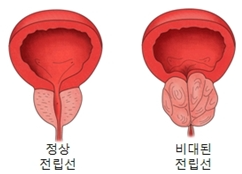 비대된 전립선