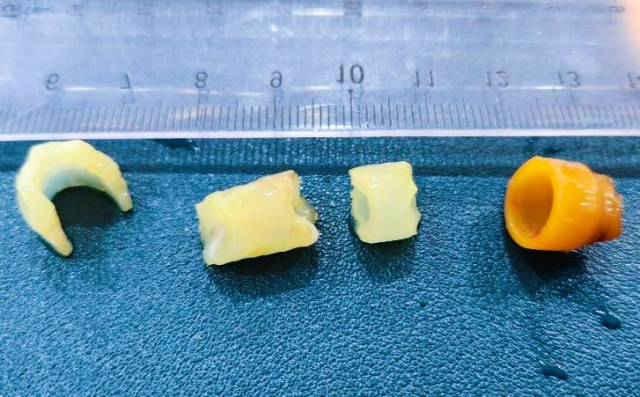 장 절개수술 후 적출 된 4개의 이물사진, 우측 제일 끝에 위치한 이물이 소장을 폐쇄한 15mm 직경의 이물이었다.박순석동물메디컬센터 제공
