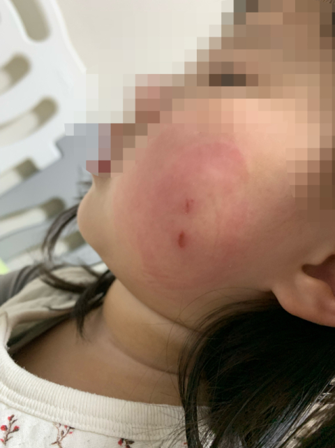 아동학대 의심 피해 아동 부모는 지난 19일 어린이집을 다녀온 딸의 얼굴에 난 상처라고 주장했다. 제보자 제공