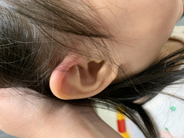 아동학대 의심 피해 아동 부모는 지난해 어린이집에서 딸의 귀가 다쳤다고 주장했다. 제보자 제공