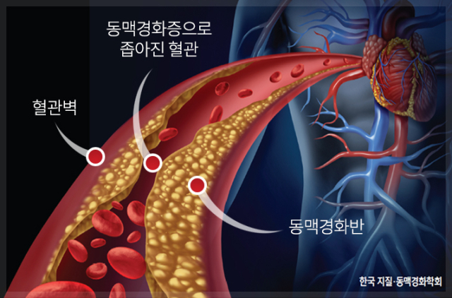 동맥경화. 칠곡경북대병원 제공