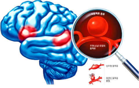 [건강플러스] 박재찬 경북대병원 신경외과 교수, 눈썹 절개 뇌동맥류 수술 1천례 돌파