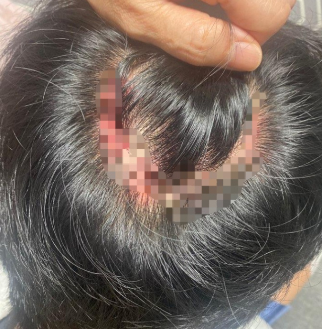 한 10대 중학생이 흉기 난동범으로 오해를 받고 경찰에게 제압당하면서 부상을 입은 가운데, 해당 학생의 부친은 