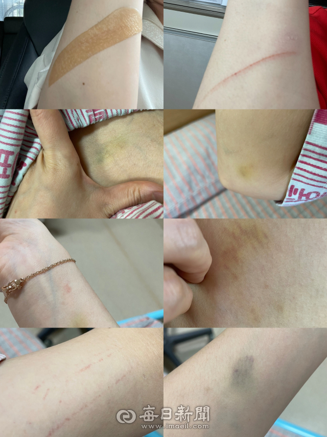 경북의 한 초등학교 교사가 지난 7일 자신이 담임으로 있던 반 학생에게 폭행을 당해 입은 상처라며 팔 등을 보여주고 있다. 김영진 기자