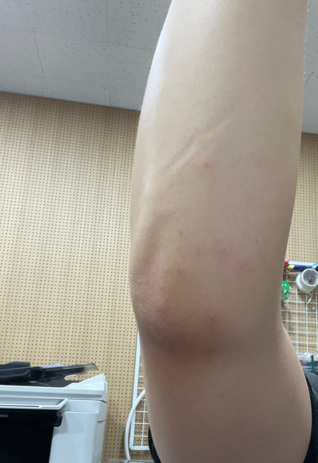 지난 4일 A씨가 대구도시철도 2호선을 이용한 다음 날 빈대에 물린 자국으로 의심되는 모습. A씨 제공
