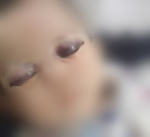 눈 피멍 든 구미 '6개월 영아'…아동학대 사례 관리 대상자였다